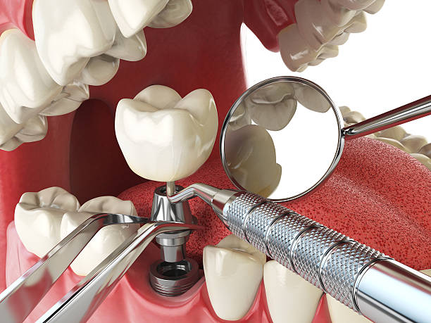 Best Emergency Dentist for Knocked-Out Tooth in Bedford Hills, NY
